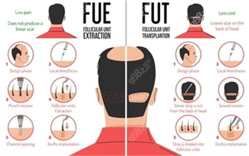 不同植发技术的成效图