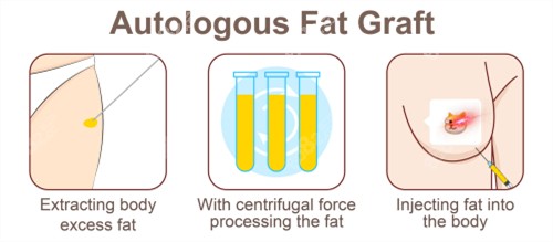 自体脂肪隆胸手术过程