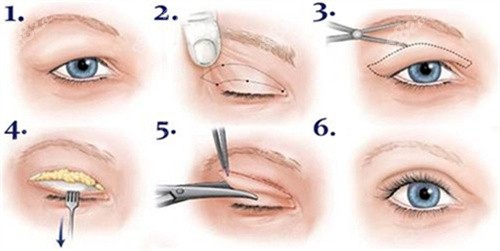 双眼皮全切术过程图.jpg