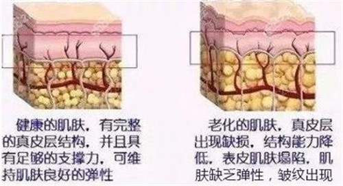 小切口smile拉皮术有什么优势？