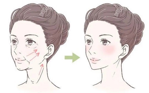 成都素美李建钢做筋膜提升怎么样