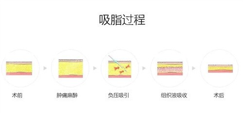 吸脂过程