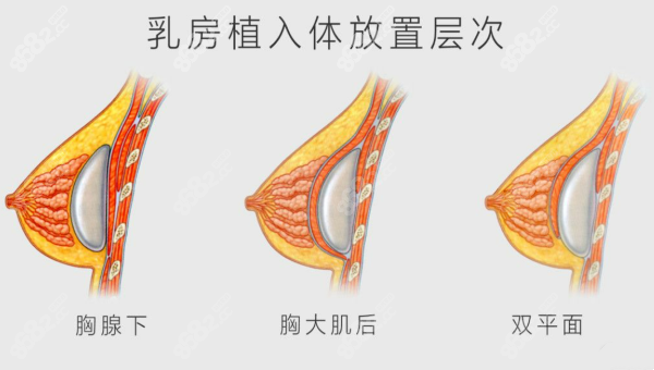 上海时光李静林医生隆胸怎么样