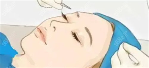 双眼皮手术过程卡通图.jpg