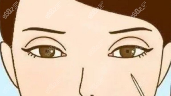 沈阳杏林双眼皮修复真人实例