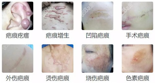 不同疤痕的类型