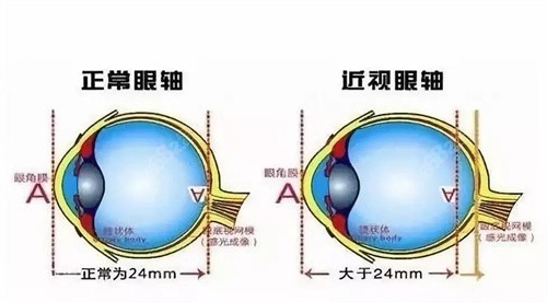 兰州爱尔眼科医院半飞秒近视手术