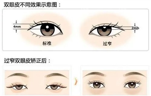 不同高度的双眼皮.jpg