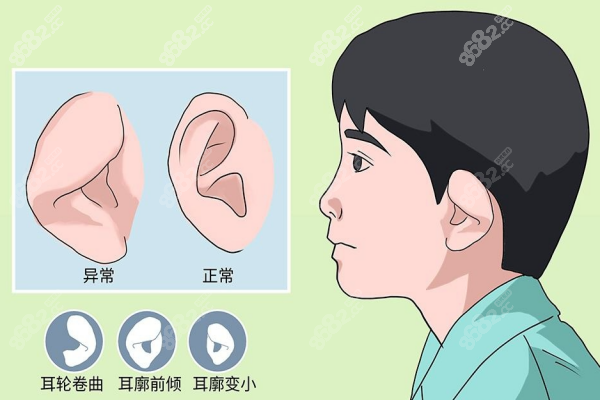 耳再造矫正问答