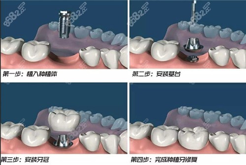 深圳港龙口腔医院陈思韩种牙好不好？