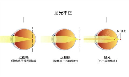 兰州爱尔眼科医院准分子激光手术价格