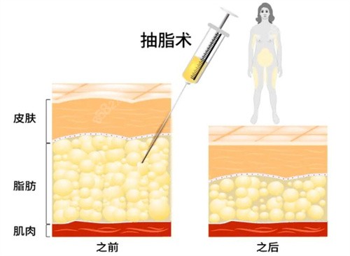 昆明梦想医疗美容医院抽脂价格表