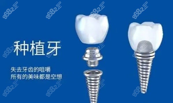 韩国种植牙为什么便宜那么多