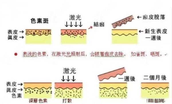 皮秒祛斑原理图