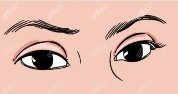 沈阳张莹莹双眼皮修复价格