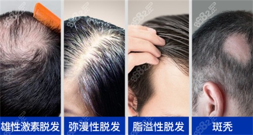 脱发类型