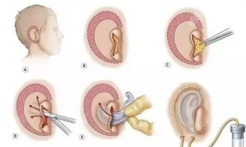 耳再造皮肤扩张.jpg