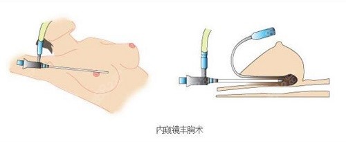 深圳阳光整形医院罗志敏医生做隆胸手术怎么样