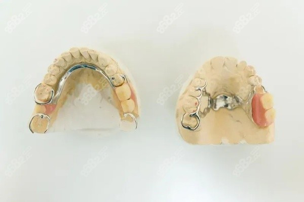 種植牙和固定假牙的區(qū)別