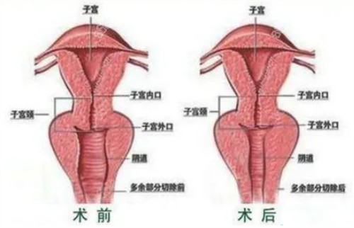 北京嘉禾医疗美容缩阴手术价格