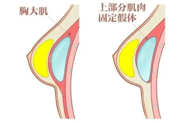 福州美贝尔医疗美容隆胸技术好不好