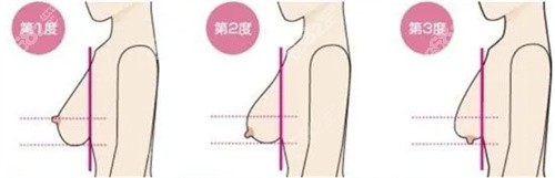 乳房下垂程度