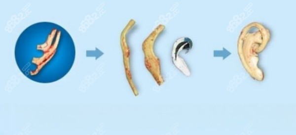 毋巨龙耳再造怎么样