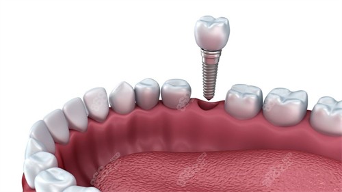 单颗种植牙种植示意图