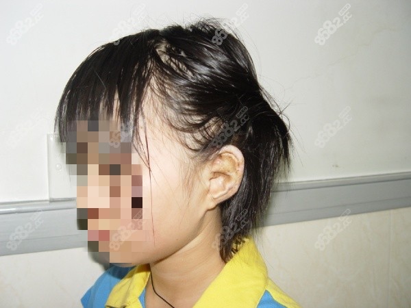 重庆毋巨龙耳再造手术实例