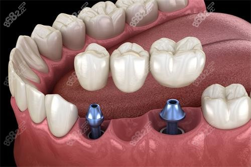 多颗种植牙示意图