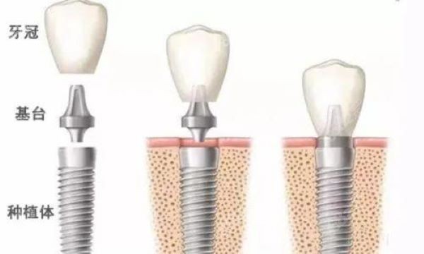 深圳拜尔口腔诺贝尔种植牙怎么样
