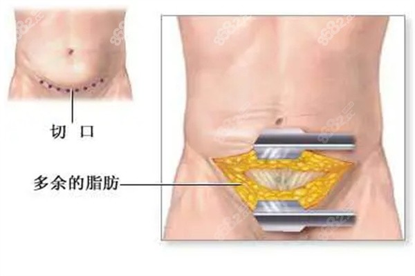 腹壁成型医生排名前十