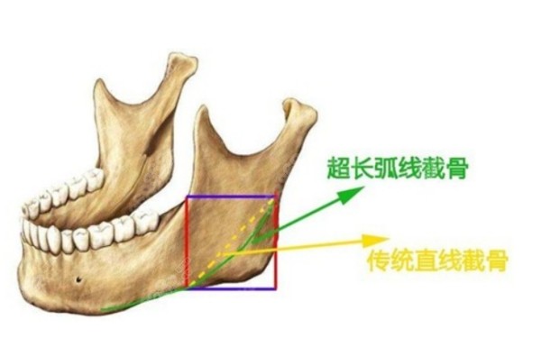 武汉中翰吴中兴下颌角手术怎么样