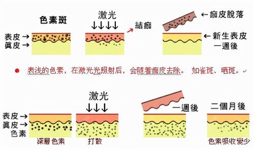 激光祛斑后的变化