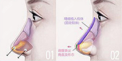 甄永环医生做鼻子技术好吗？