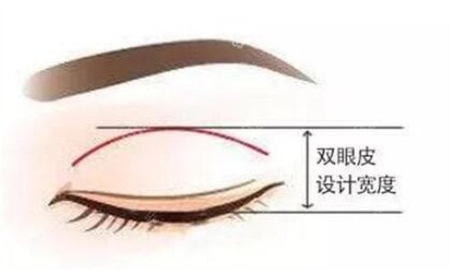 车红昌医生做双眼皮怎么样？