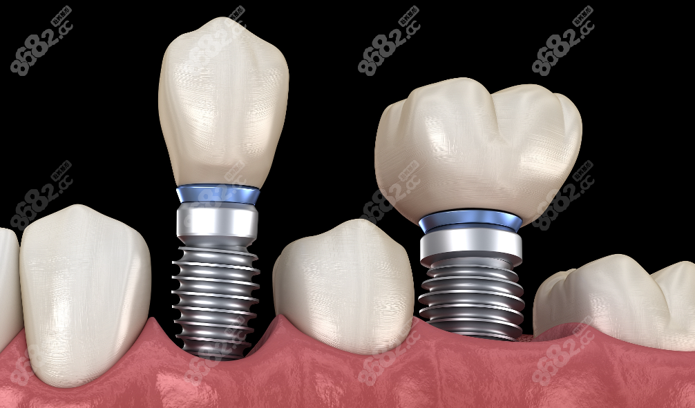 种植牙手术示意图