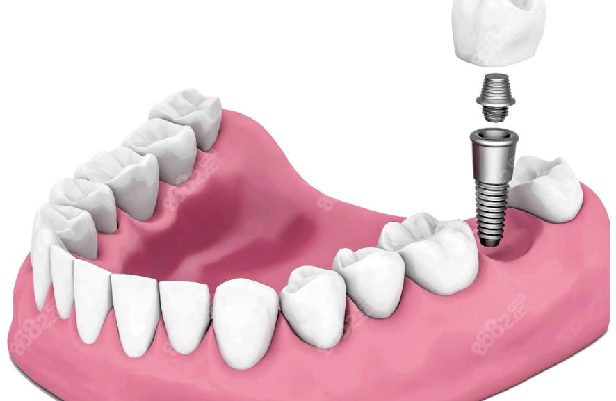 种植牙示意图