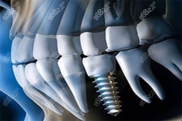 天津中牙口腔医院种植体