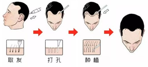 植发过程示意图