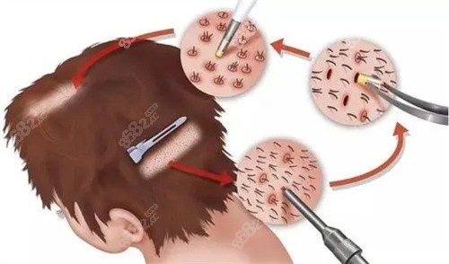 毛发移植提取示意图