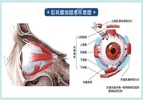 后巩膜加固术4万贵吗