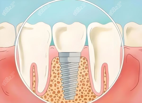 上海鼎植口腔种植牙怎么样