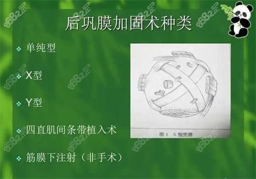 后巩膜加固术4万贵吗