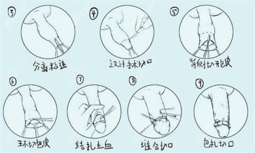 割包皮手术过程