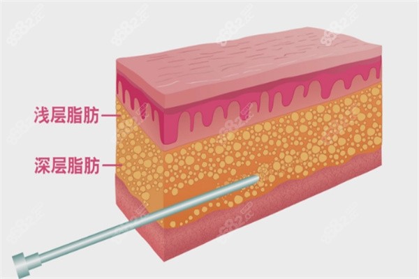 边志超吸脂技术