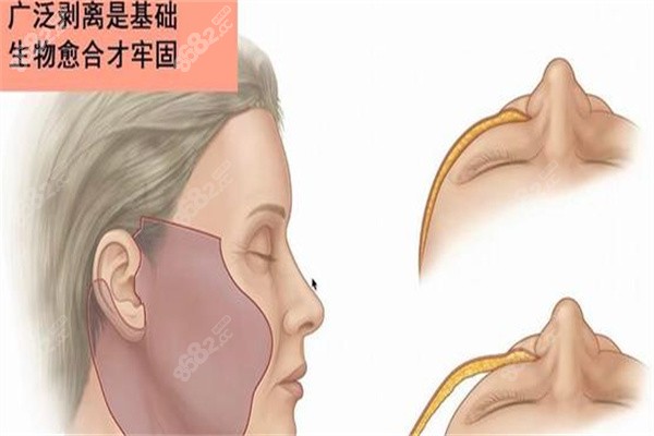 内窥镜SMAS筋膜面颈大拉皮