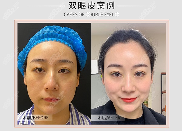 黄昕昕做眼睛修复技术