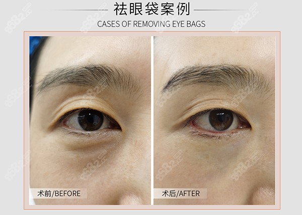 黄昕昕做眼睛修复技术