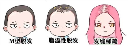 脱发种类